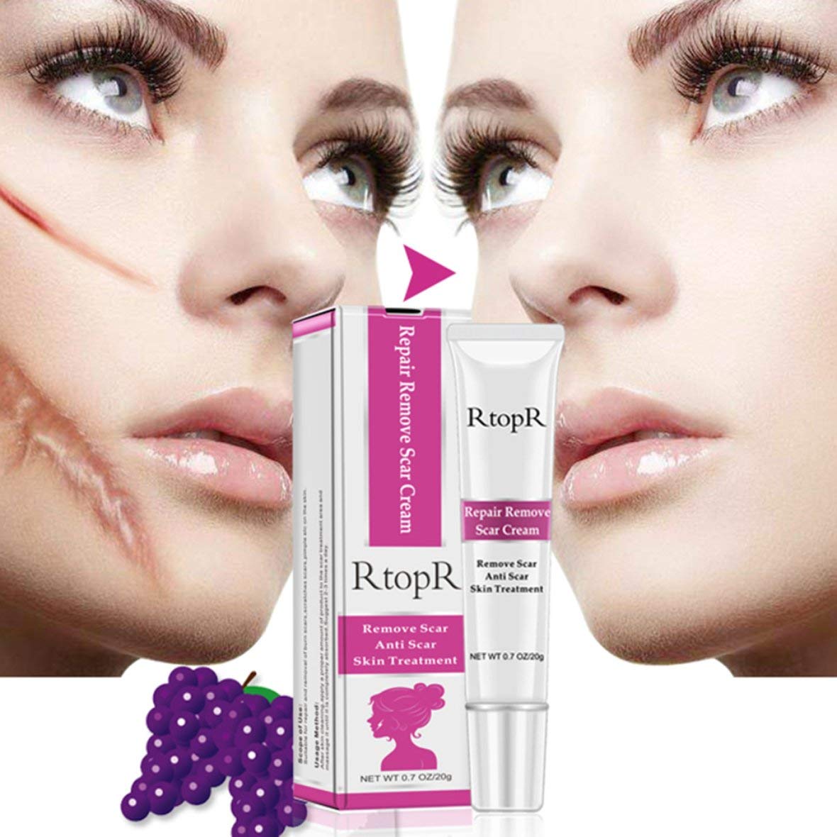RtopR Acne Scar Removal Cream Fast Skin Tag Remover Remove Scar Cream