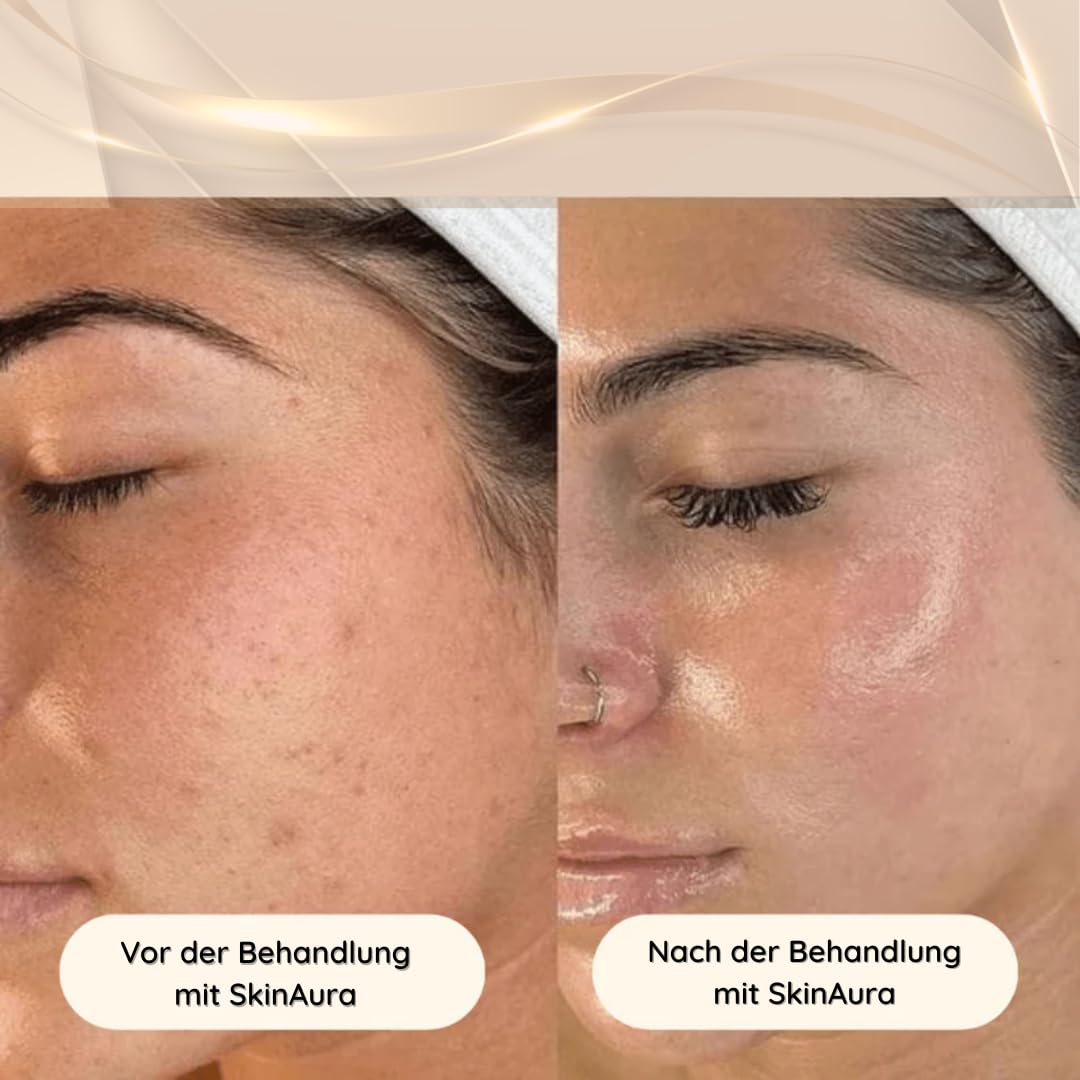 SkinAura Hochfrequenzstab Gesicht, Haare & Body mit 6 Elektroden | Akne, Faltenreduktion, Anti-Aging, Haarpflege | Gesichtsmassagegerät, HF Stab, Darsonval | Vielseitige Aufsätze für Gesicht, Kopfhaut & Körper
