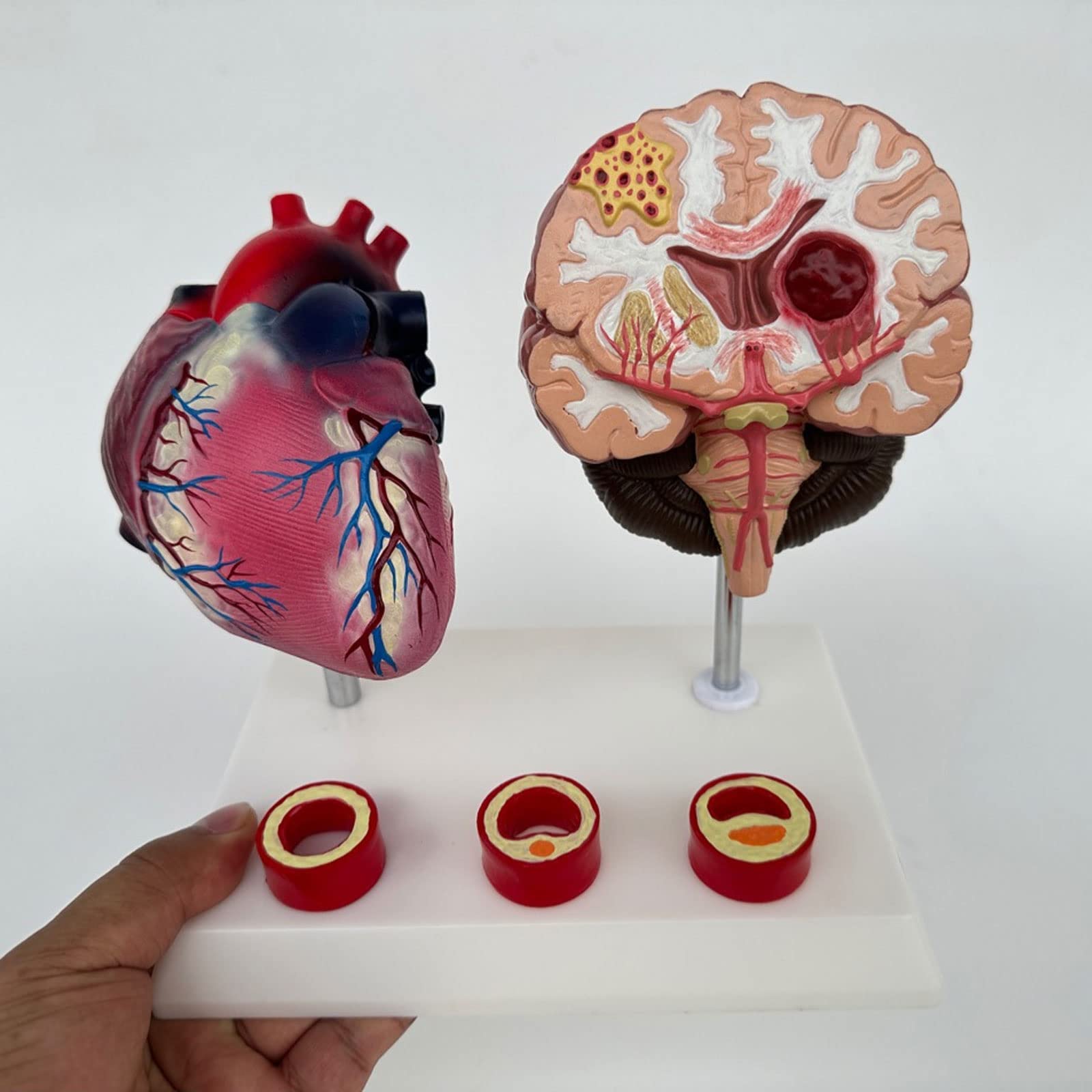 Amazon.co.jp: ヒト心臓模型 循環器病学 閉塞過程模型 教育 医学