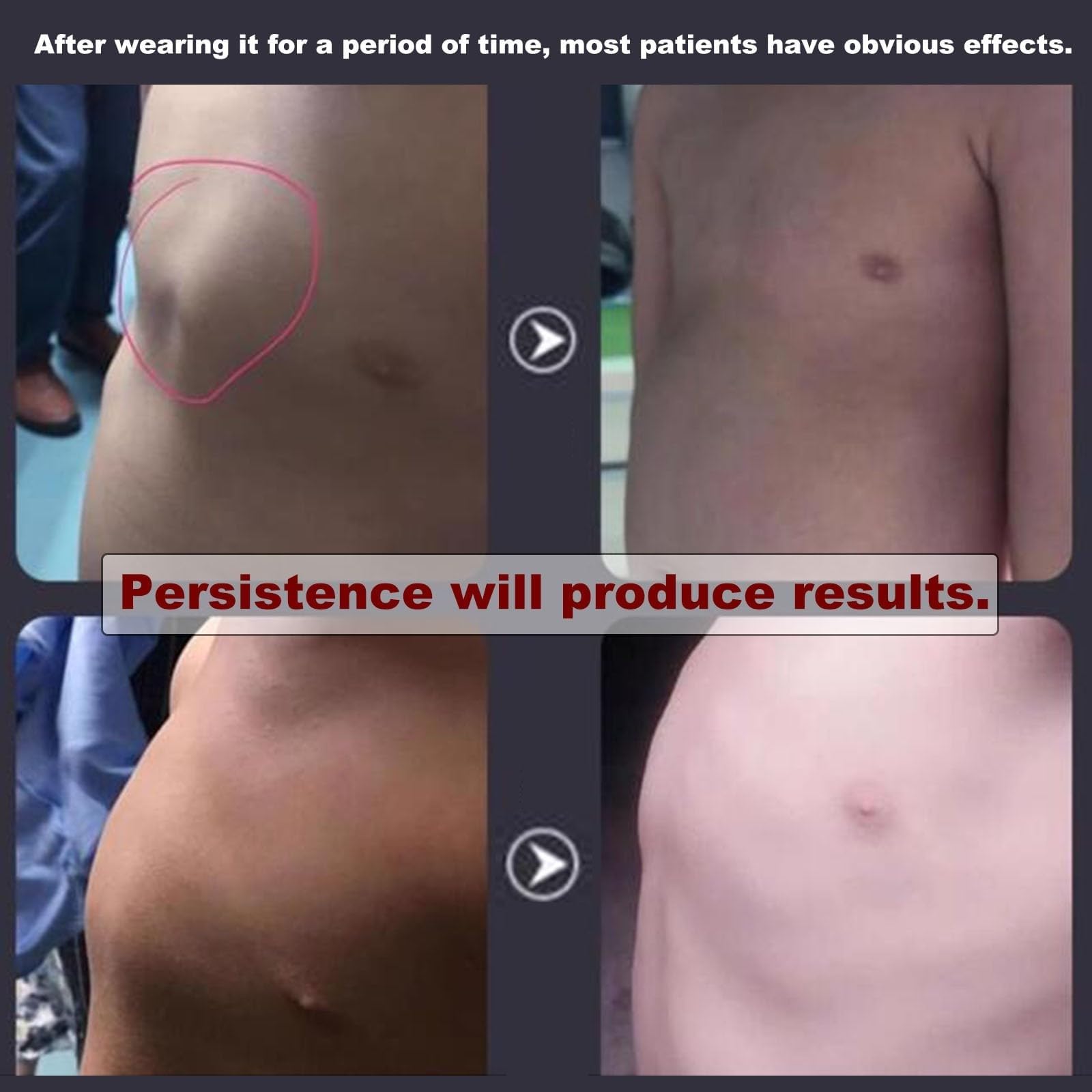 Ortesis para Pectus carinatum: Soporte torácico de Paloma para niños, ortesis para esternón deformado, ortesis para Costillas valgas, tamaño Ajustable, Transpirable(A)