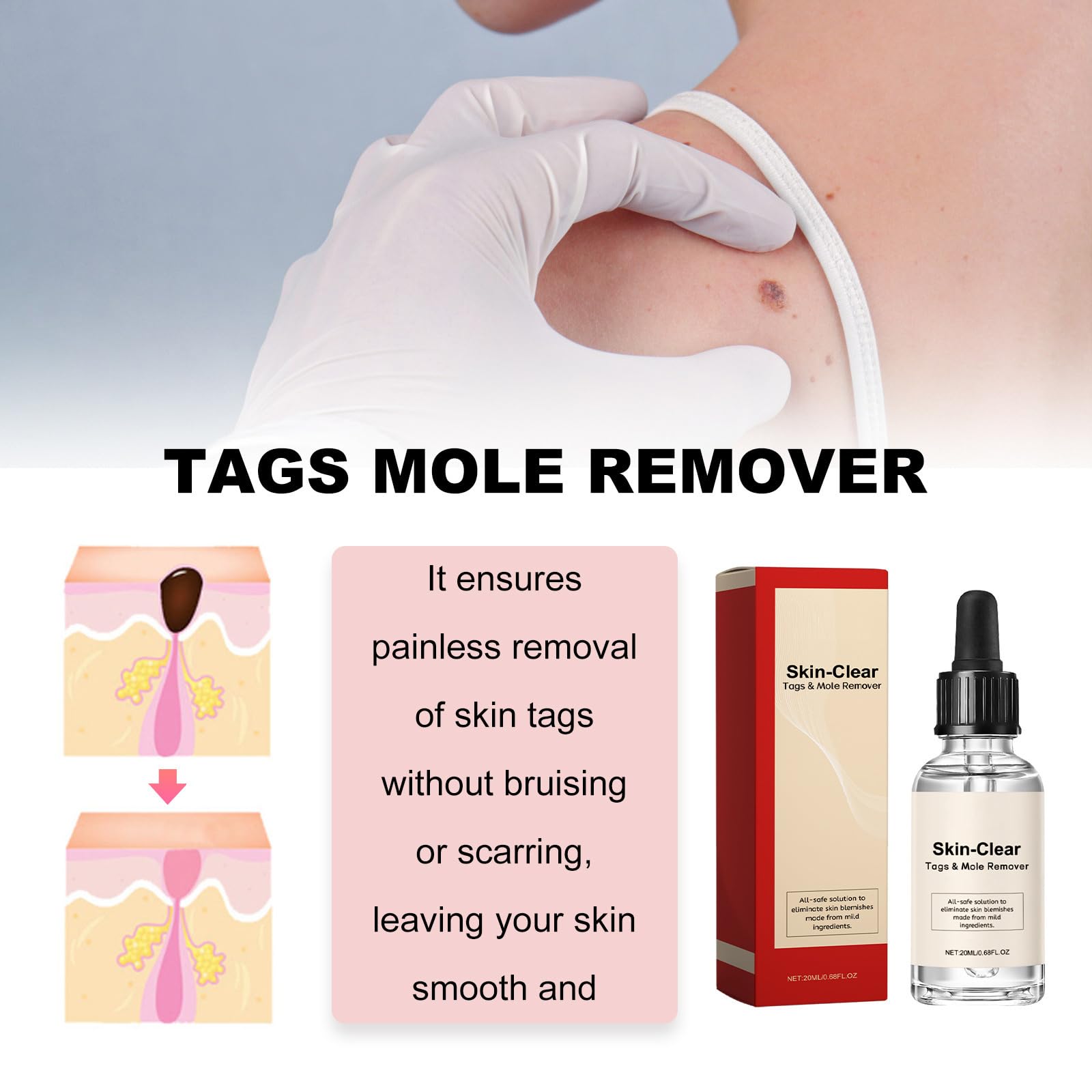 Lotion pour Enlever les Taches Noires de Naevus et les Taches Sombres, Crème Anti-Taupes et Verrues, 20 ml