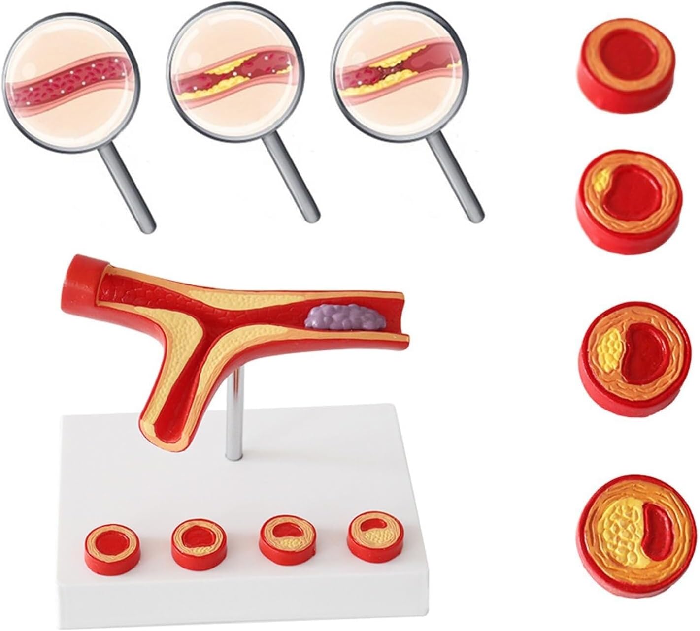 Coronary Artery Cardiovascular atherosclerosis Model, Thrombosis Model, Thrombosis Model atherosclerosis Model, Human Blood Vessel Model, Human atherosclerosis Thrombosis Model