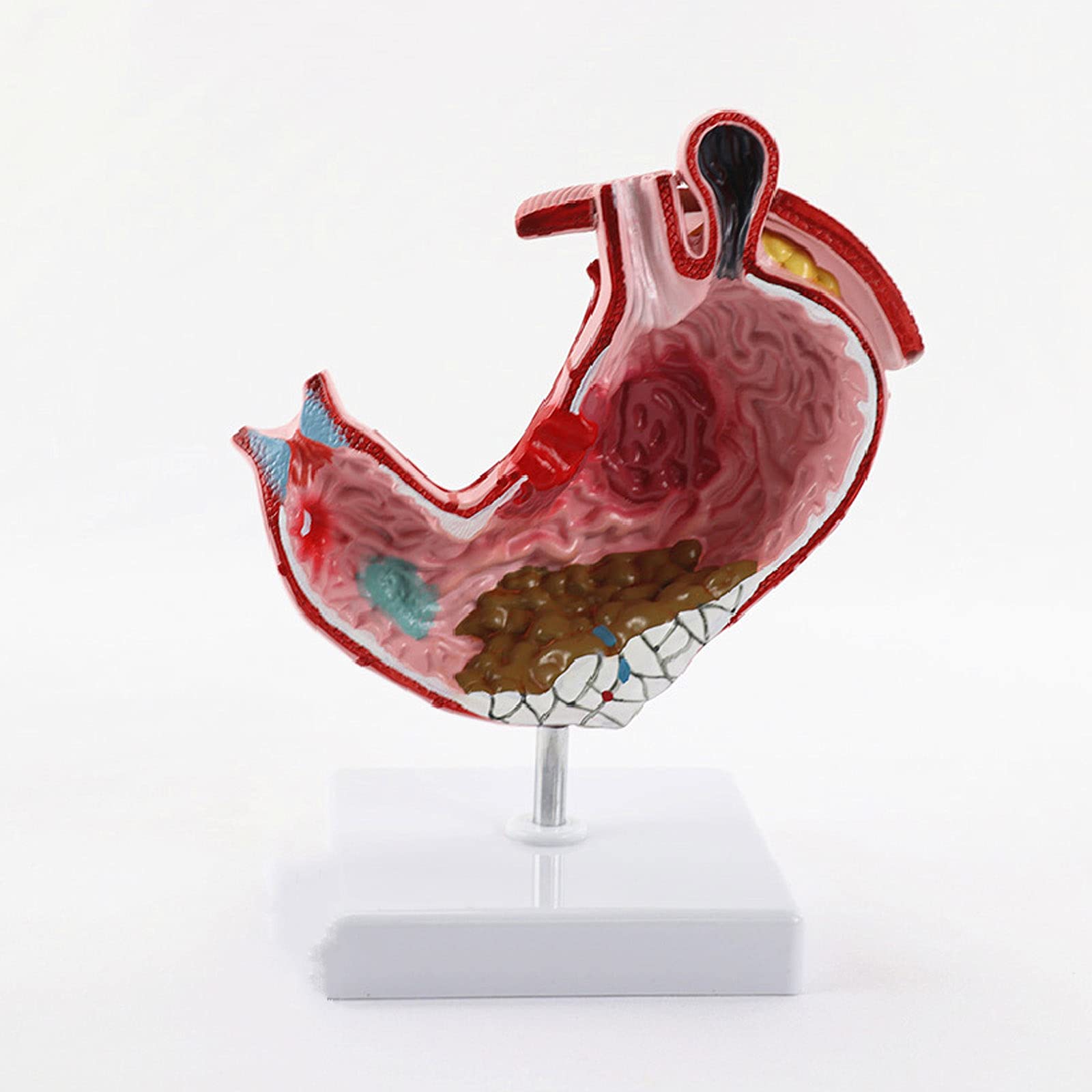 STZJBD Human Stomach Model, Gastric Diseases Anatomy Model, Medical Teaching Anatomical Model & Educational Model
