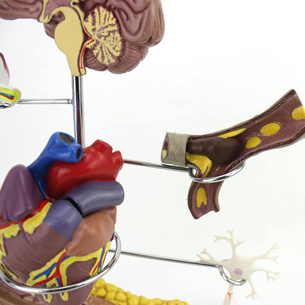 Medyczny Model Cukrzycy, Model Patologii Cukrzycy, Materiał PVC Patologia Cukrzycy Serce, 8 Części Zdejmowany Model Narządu Dla Studentów Anatomii I Fizjologii