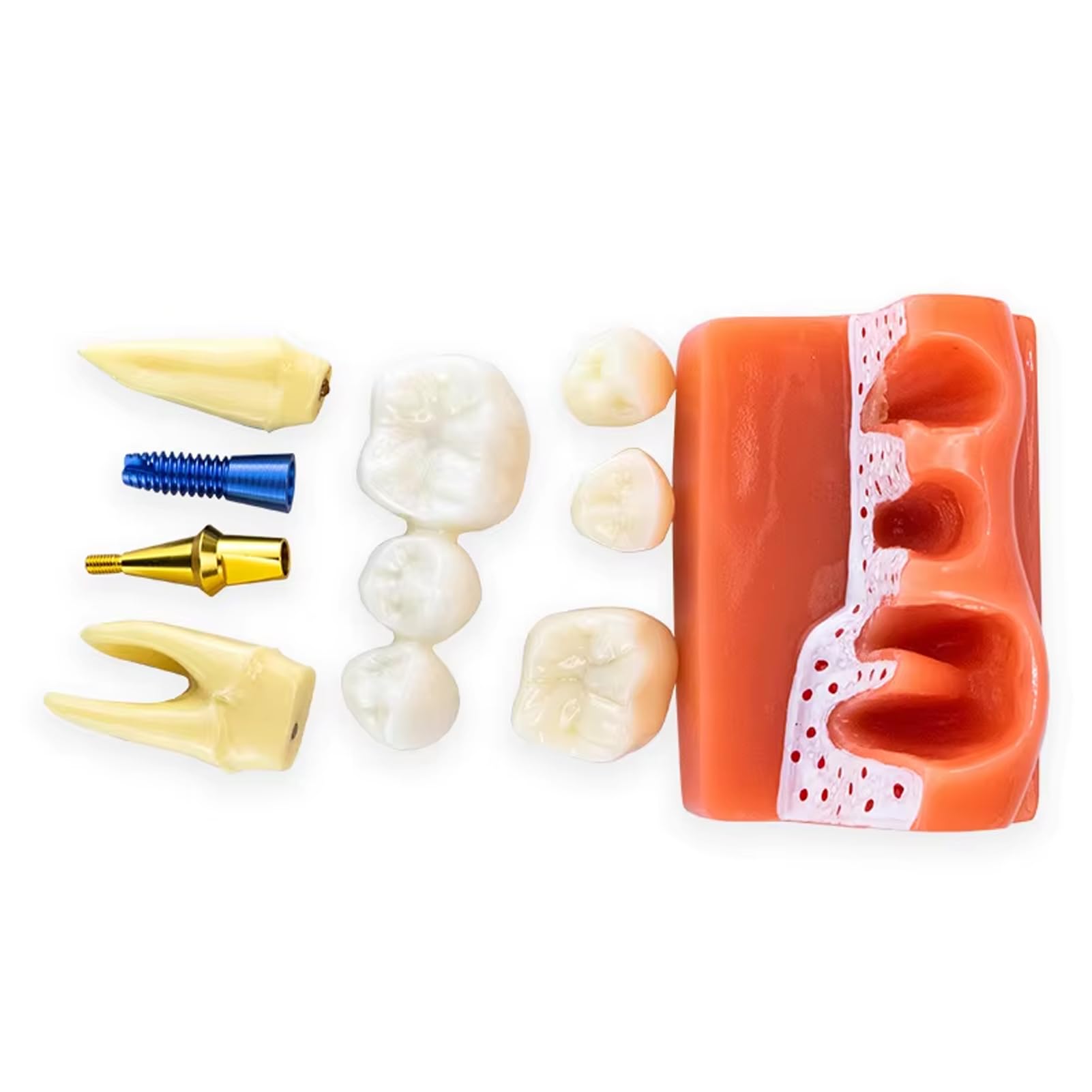 Dental Implant Model, 4 Times Transparent Teeth Model with Analysis Crown Bridge for Stutent Study and Teaching Demonstration (Red)