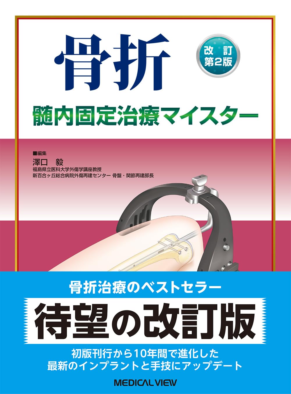 骨折 髄内固定治療マイスター 改訂第2版 改訂第2版 骨折 髄内固定治療マイスター | 澤口 毅 |本 | 通販 | Amazon