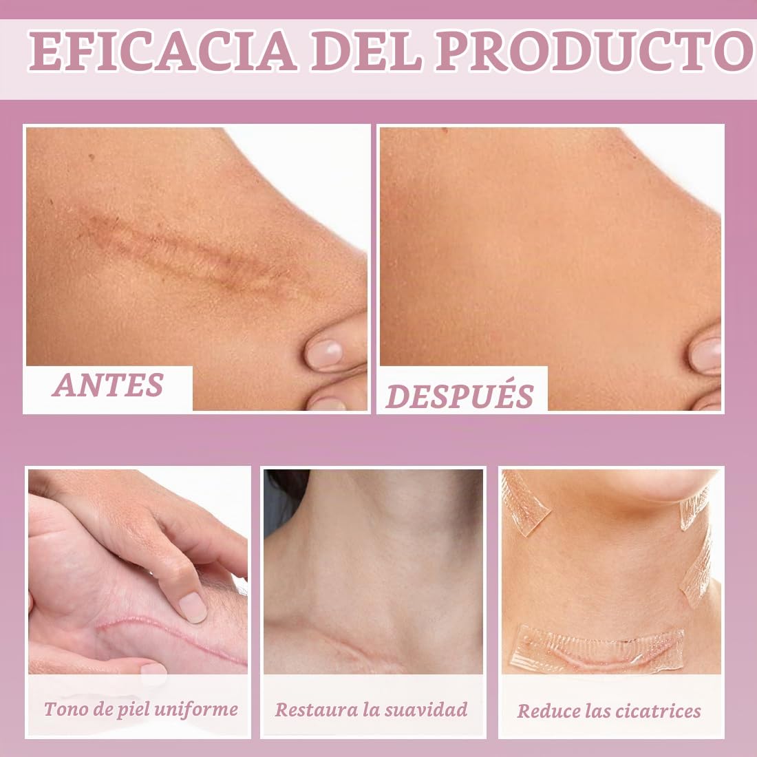 2 Piezas de láminas de Silicona para Cicatrices,Parches de gel para la Cara,Transparentes,Diseño Invisible, Cubren Eficazmente las Cicatrices, 4 cm x 150 cm