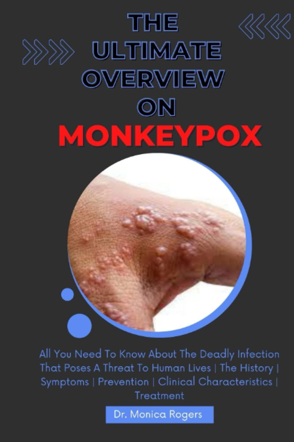 THE ULTIMATE OVERVIEW ON MONKEYPOX: All You Need To Know About The Deadly Infection That Poses A Threat To Human Lives | The History | Symptoms | Prevention | Clinical Characteristics | Treatment