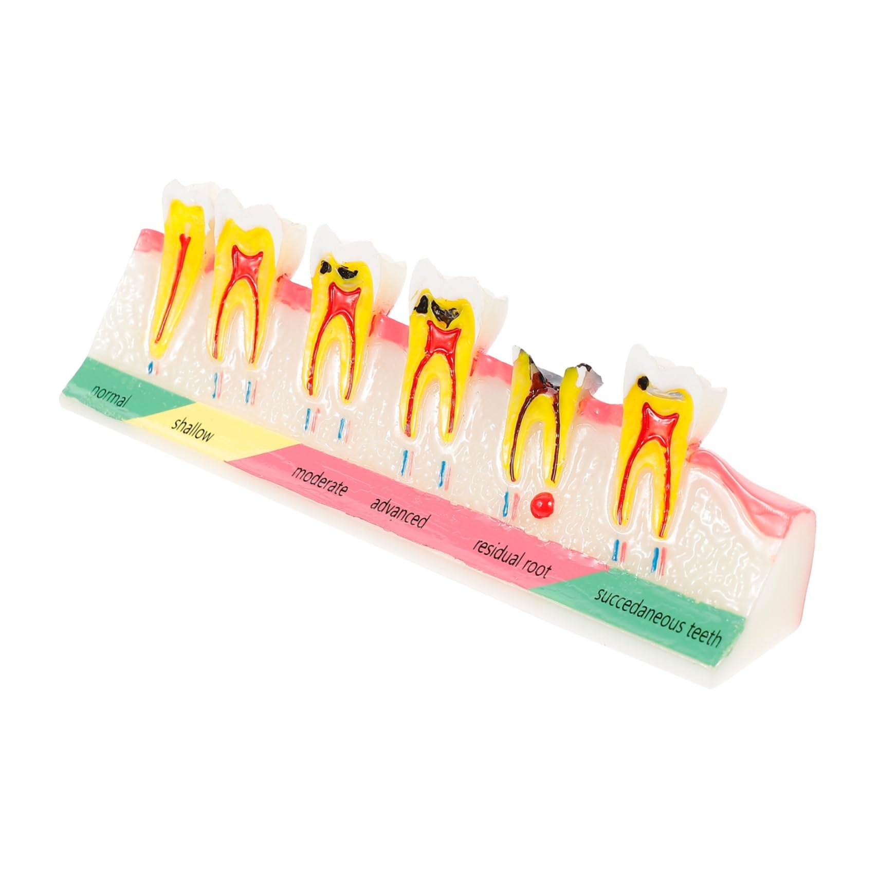 Alipis Modello Didattico di Denti Carie Resistente per Corsi Odontoiatrici, Strumento Dimostrativo per Studio e Lezioni di Igiene Orale, Modello Educativo Professionale per Studenti