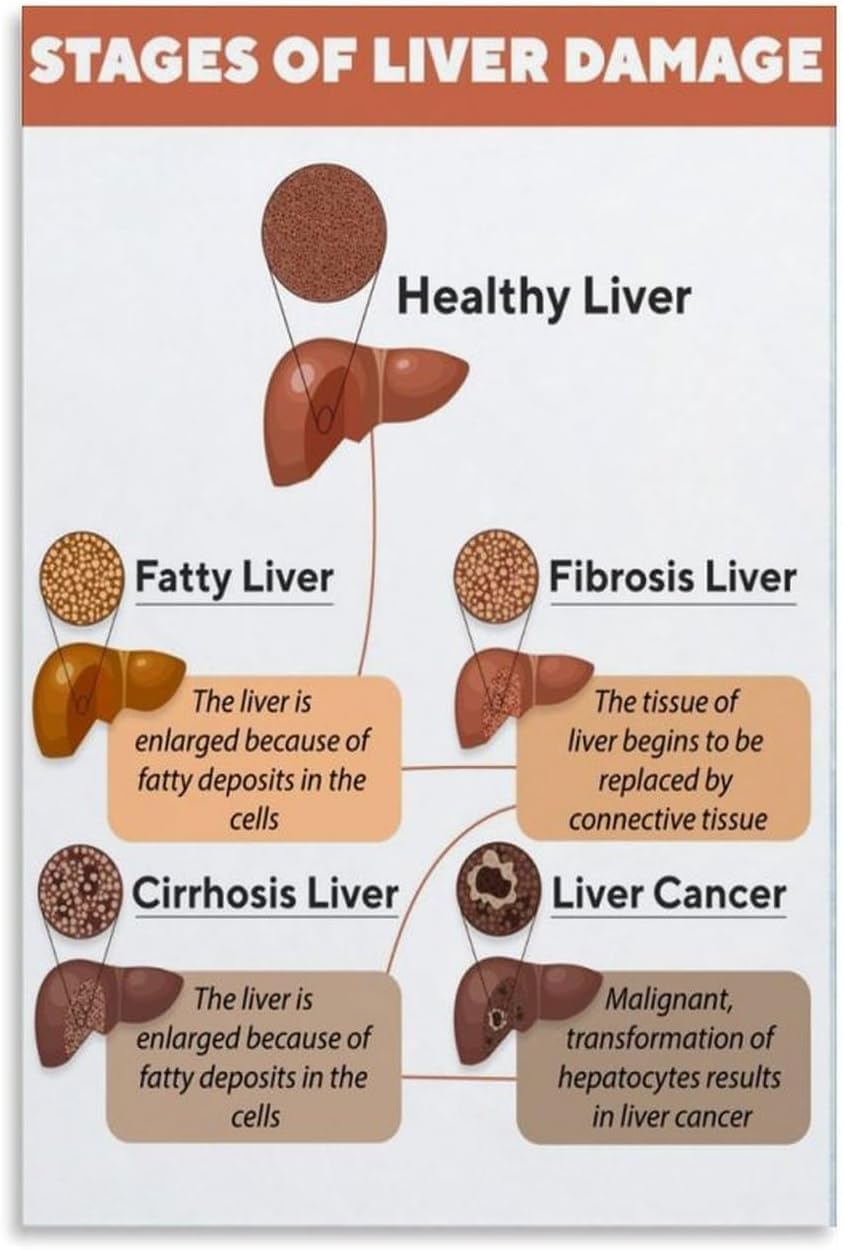 Sitrmgh Men's Educational Posters Stages Of Liver Disease Damage Symptoms Knowledge Chart Poster For Room Aesthetics Meatl Tin Sign Wall Art 8X12 Inch