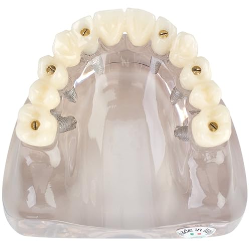 Practicon 4112161 Modelo de implante de arco completo retenido con tornillo