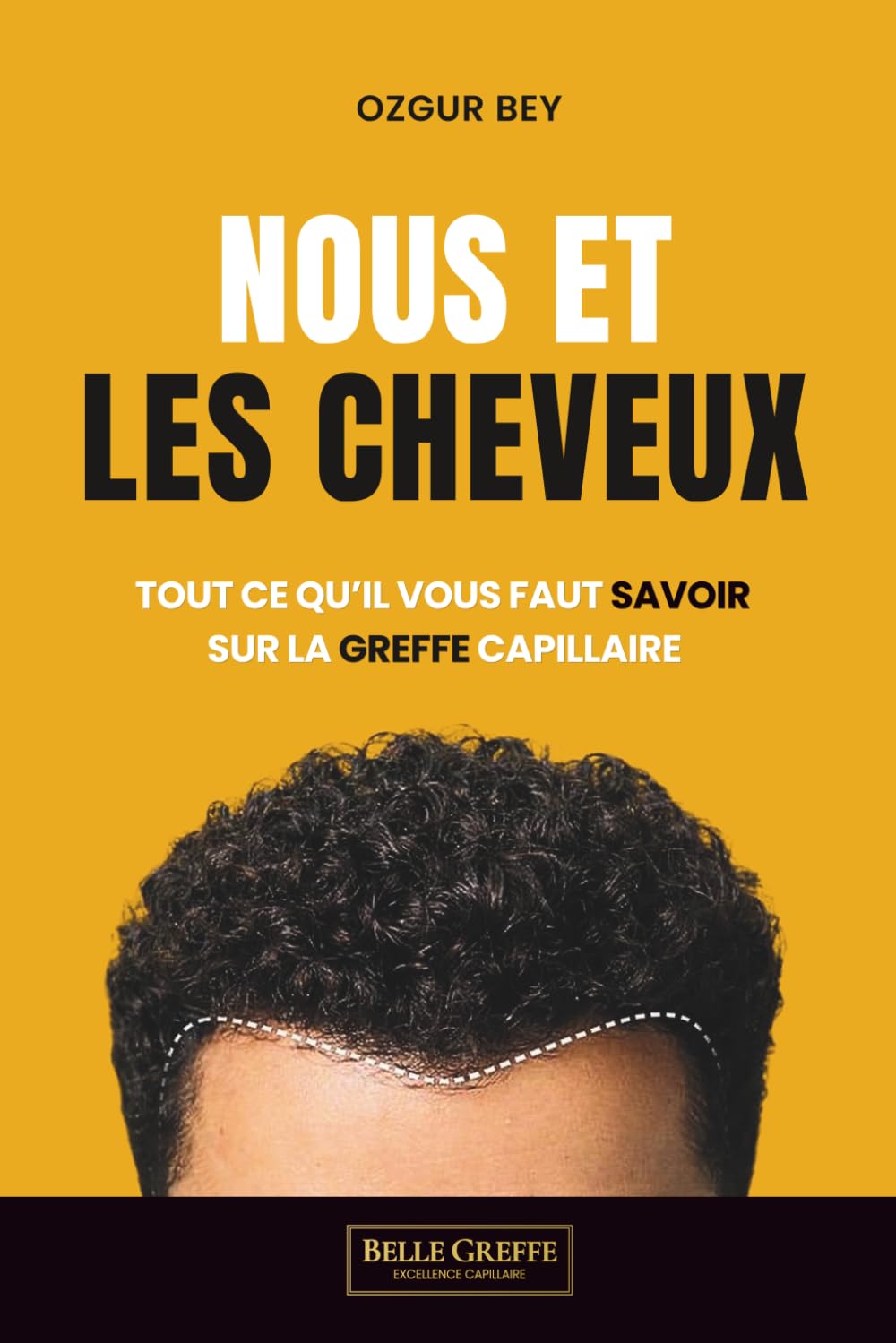 Nous et les cheveux: Tout ce qu'il vous faut savoir sur la greffe capillaire
