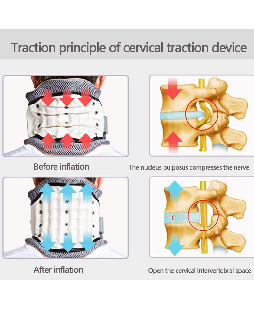 Dispositivo portátil de tracción del Cuello Cervical, Soporte para el Cuello Cervical Ajustable, fijador del Cuello Cervical inflado, Soporte para el Cuello para Artritis, Azul (Blanco)