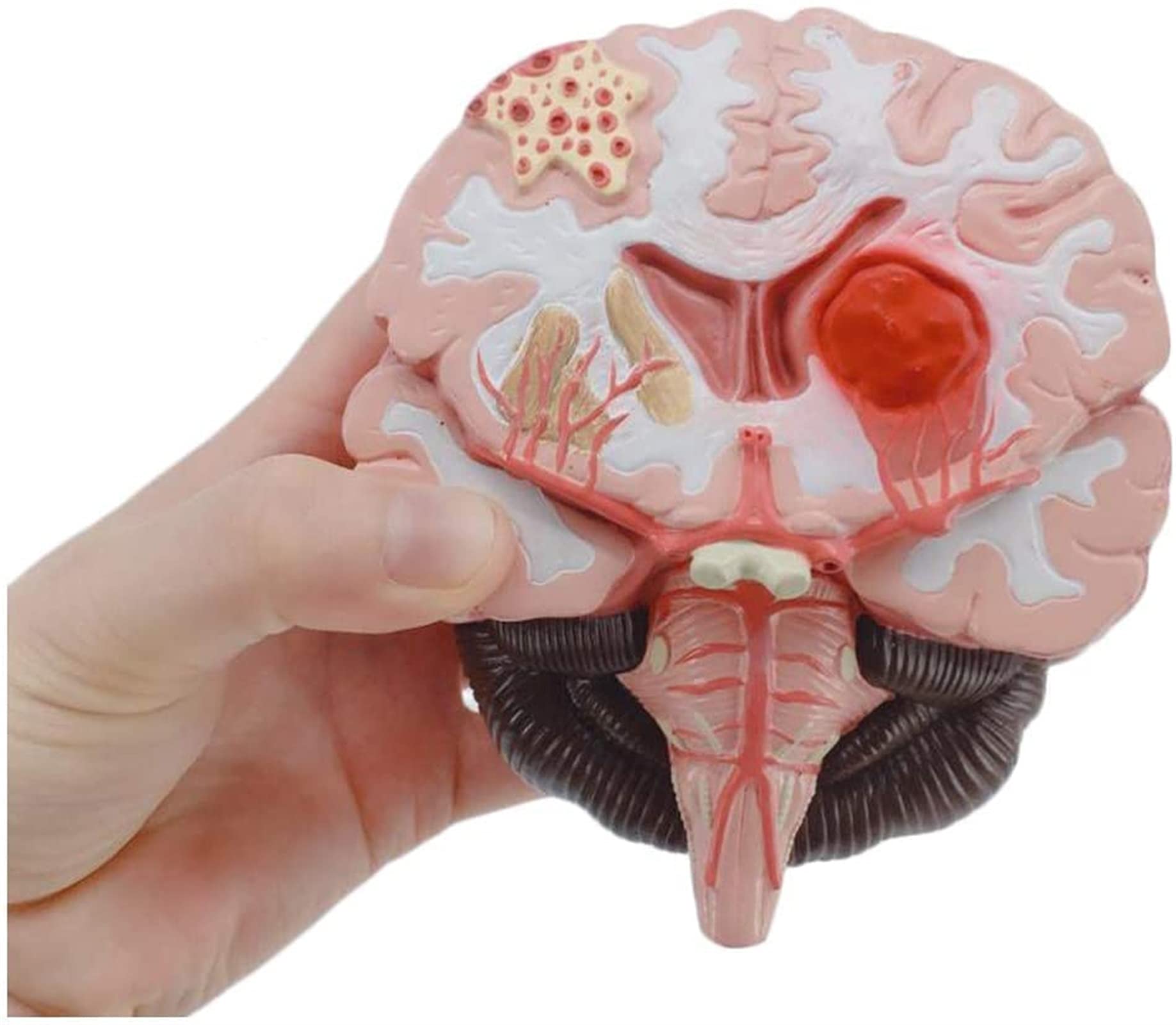 Educational Model Anatomical Brain Model Malformed Brain Pathological Structure Model Cerebral Cortex Gray Matter Brain Stem Hemorrhage Arteriovenous Anatomy Model Medical Models
