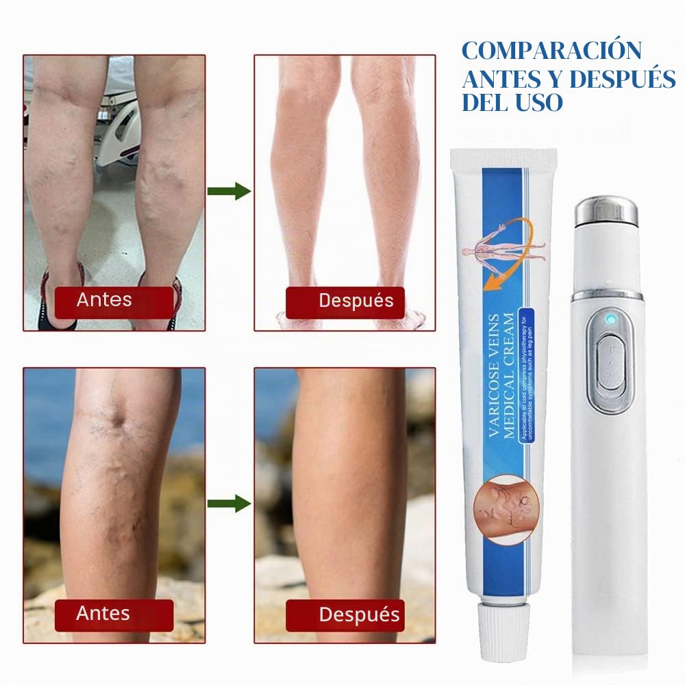 Veinshealth - Terapia de luz azul para venas varicosas (2 cremas + 1 bolígrafo)