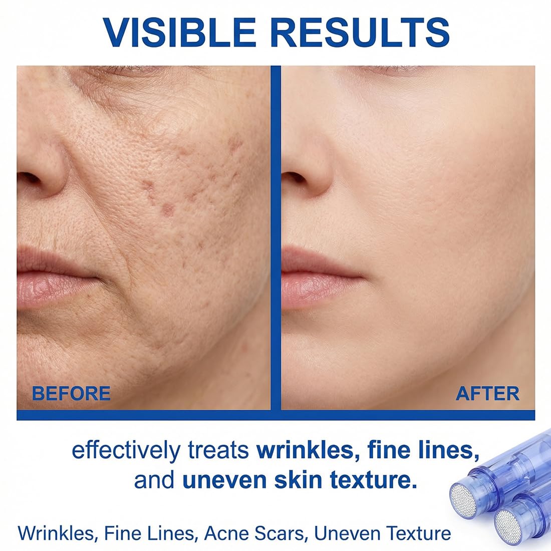 Set da 8 Microaghi, 36 Aghi, Punte Micro/Nano, Ricambi per Dispositivi di Microneedling. Punte di Ricambio per Penne Microneedling