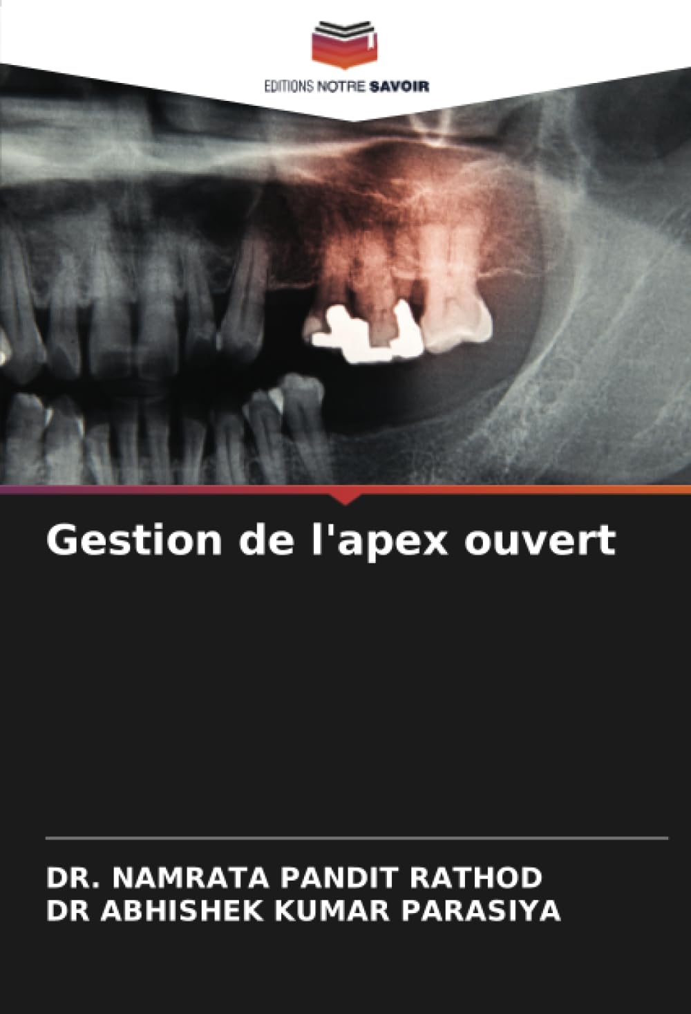Gestion de l'apex ouvert