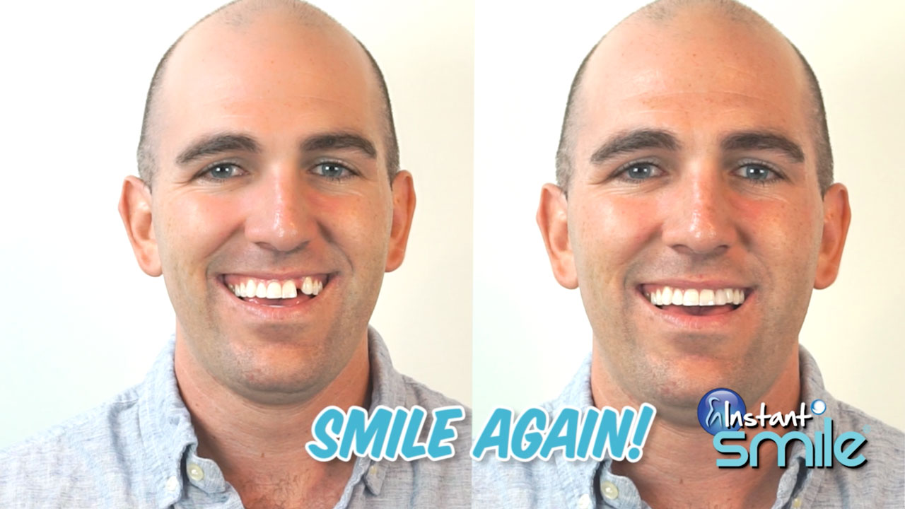 Amazon.com : Instant Smile Triple Shade Temporary Tooth Kit