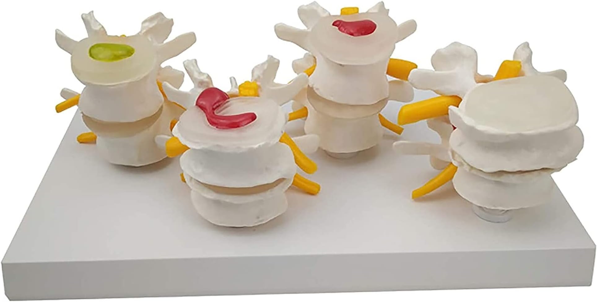 Study Model Spine Lumbar Disc Herniation Model Human Lumbar Vertebral Spine Anatomy Model of Vertebrae Lumbar Lesion Model