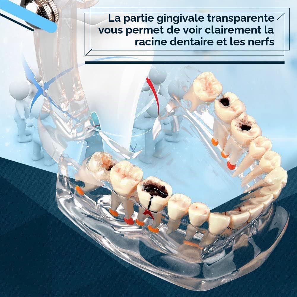 Walfront Modèle de Dents Amovibles, Transparent Dentaire Implant Disease Enseignement Étude Standard Dents Modèle Démonstration Pathologique