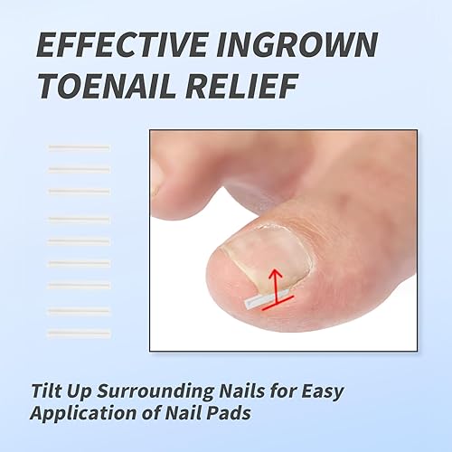 Miniatura 6 de Paquete de 62 tiras correctoras para uñas encarnadas, herramienta de corrección profesional, alisador curvo para alivio de uñas encarnadas en casa