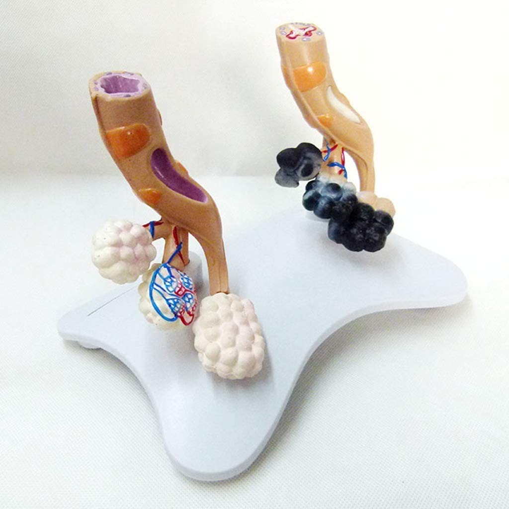 Educational Modell alveolar Modell - Vergleichende Anatomie Alveolen Rauchen und gesundes Zellmodell der medizinischen Studie - Anatomisches Modell