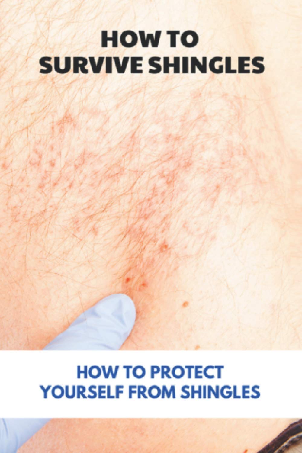 How To Survive Shingles: How To Protect Yourself From Shingles: How To Speed Up Shingles Recovery