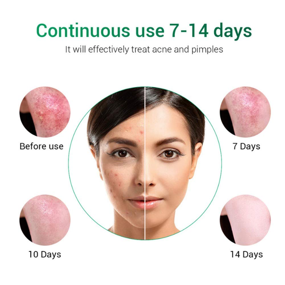 Reparación del acné cicatrices Crema antiacné facial Crema antiacné Crema antiacné Pimple Oil Control Reencoger los poros Sérum Hidratante para la cara