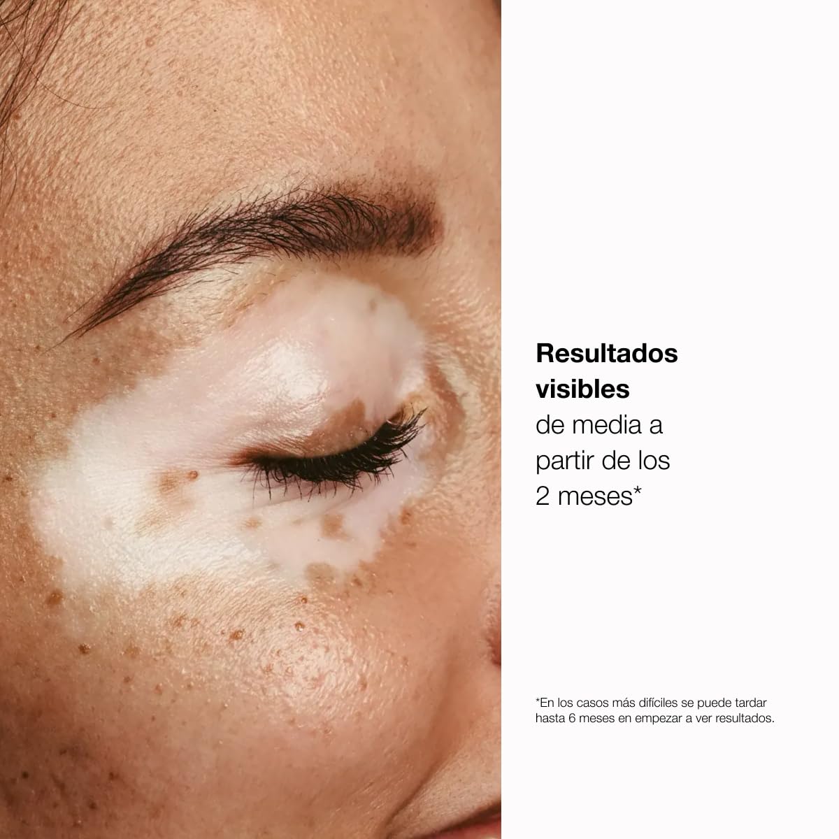 Repigment12 Plus Crema Repigmentante