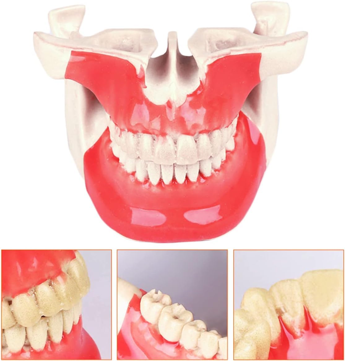 Model zęba Choroba implantu dentystycznego Model zębów Student Materiał żywiczny Zestaw do nauczania ustnego