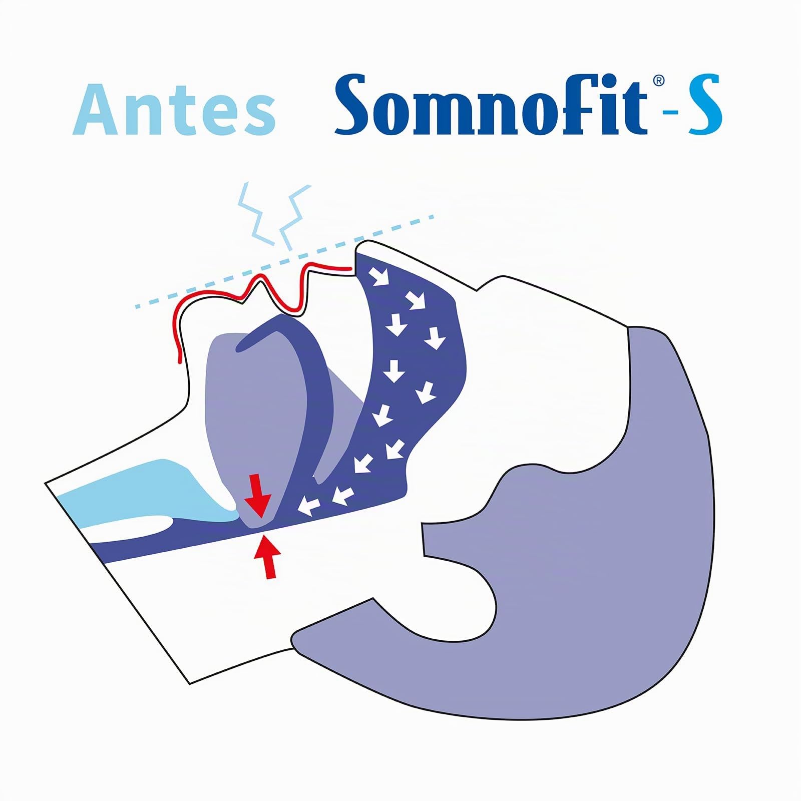 Somnofit-S - Férula dental - Antirronquidos - Solución para la apnea - Solución para el ronquido - Dispositivo de avance mandibular