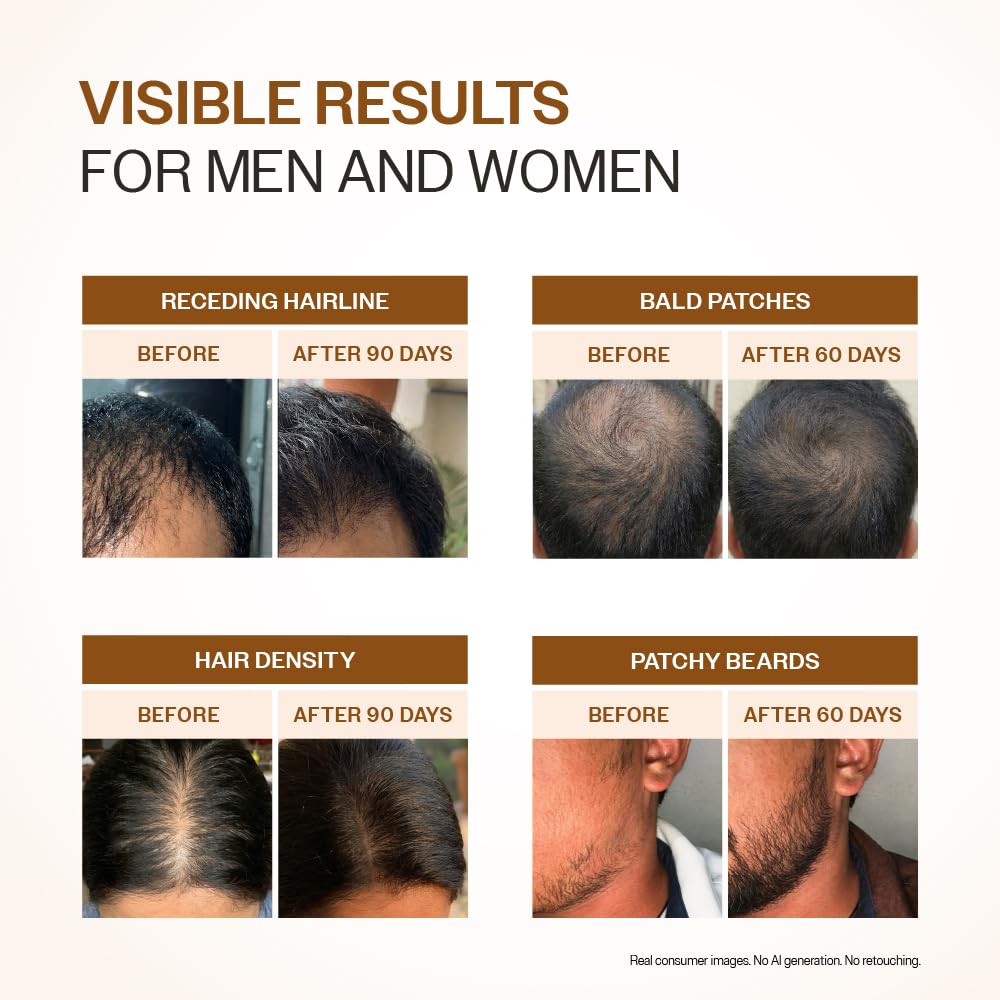 Bare Anatomy Sérum avancé de croissance des cheveux | 3% Redensyl – 2 fois meilleurs résultats que le minoxidil | + 4% Anagain + 3% Baicapil | Romarin, Biotine | Sérum de contrôle de la croissance