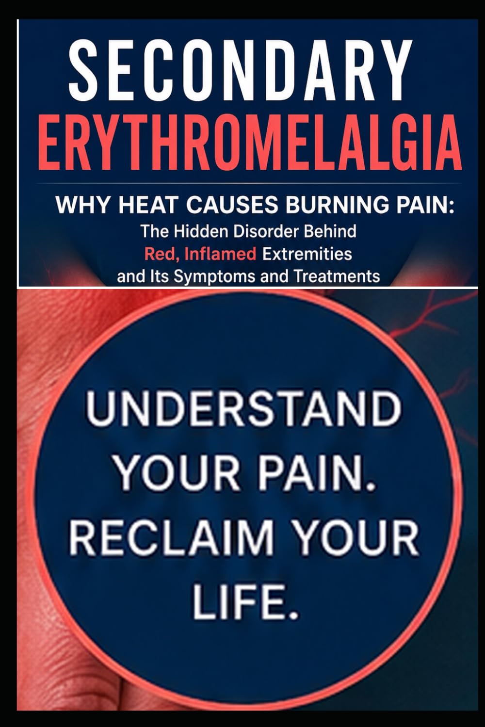 Secondary Erythromelalgia Why Heat Causes Burning Pain: Inflamed Extremities and Its Symptoms and Treatments.