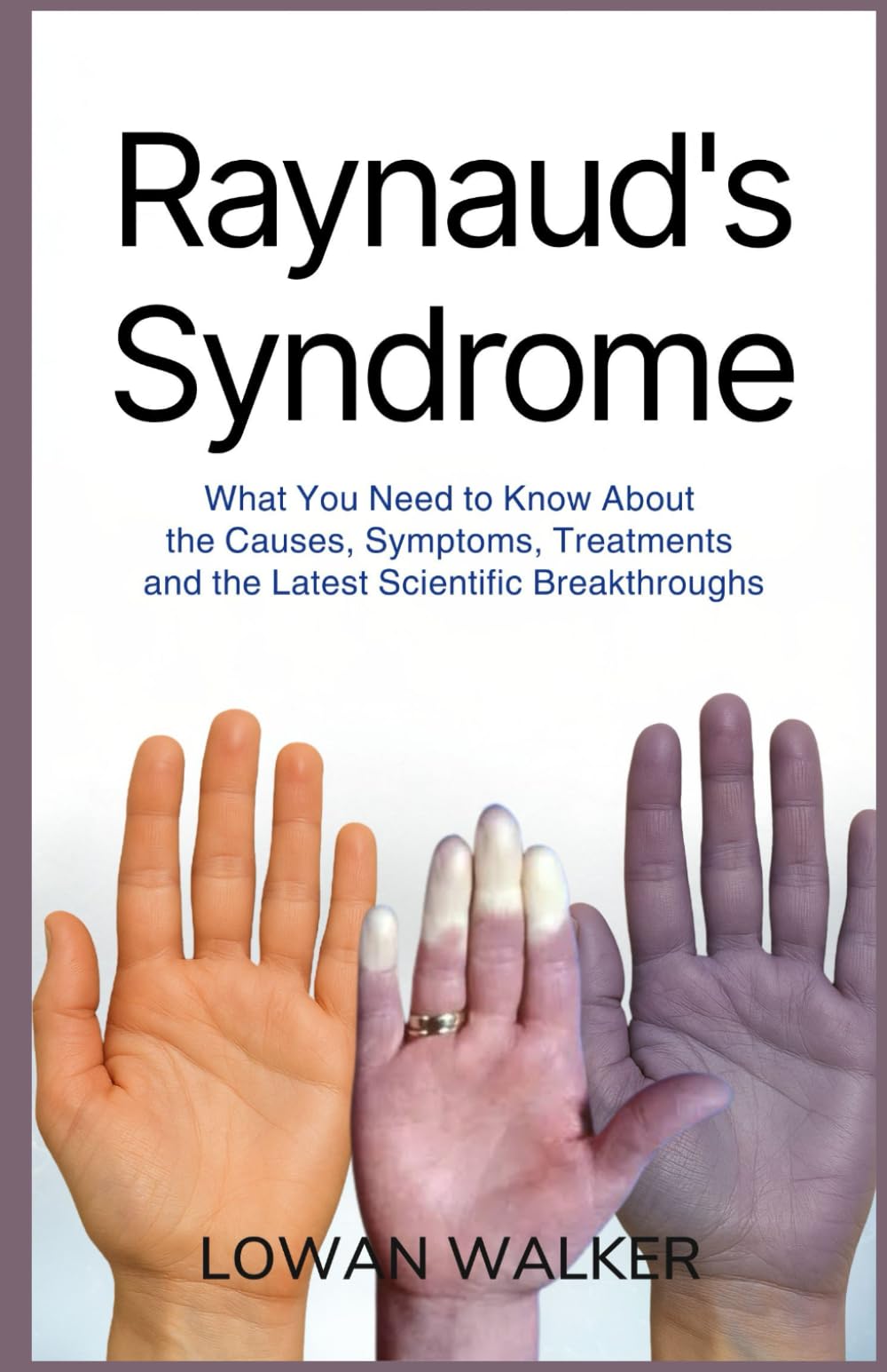 Raynaud’s Syndrome: What You Need to Know About the Causes, Symptoms, Treatments, and the Latest Scientific Breakthroughs
