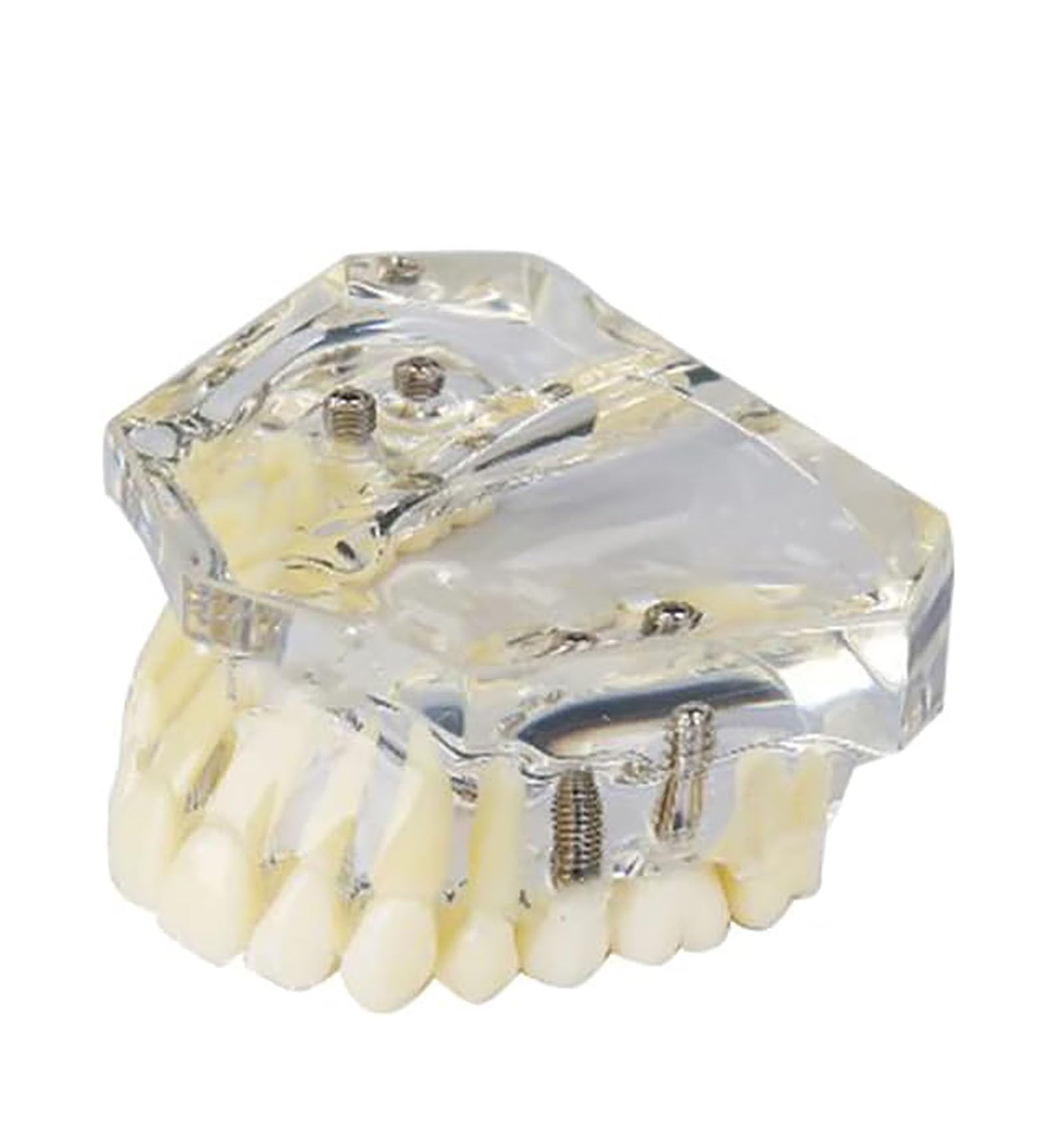 TEmkin Studienmodell, Zahnmodell, Harz-Oberkieferimplantatmodell, Transparentes Hinteres Zahnimplantat, Restaurierung, Zahnstudie, Lehrmodell, Modell für Die Zahnarztpraxis