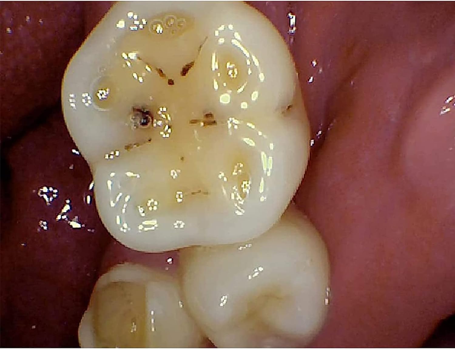 DKULMN Macchina Fotografica Orale Dentale, endoscopio intraorale Senza Fili, Macchina Fotografica intraorale Dentale HD USBWireless, 6 Mega Pixel per l'ispezione Orale