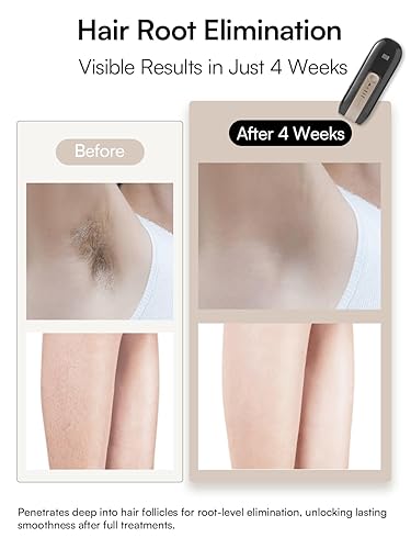 Miniatura 4 de INIA Dispositivo de depilación láser para mujeres y hombres, removedor de pelo INIA Fond con reducción de cabello de larga duración para cuerpo y