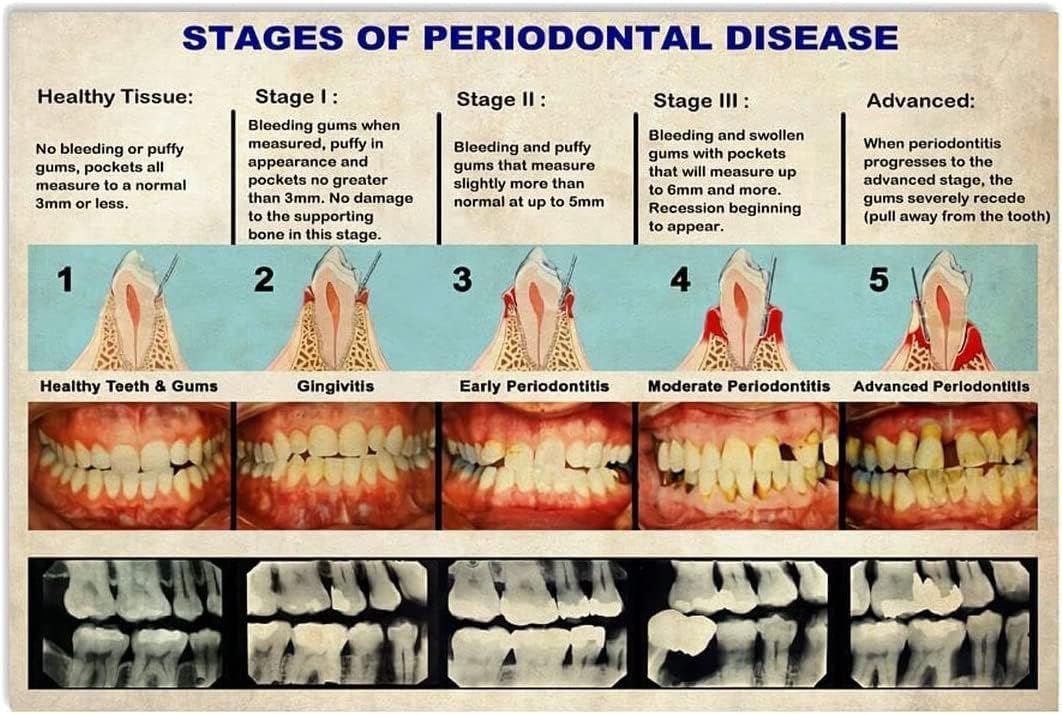 Dental Knowledge Metal Tin Signs Wall Decor Stages Of Periodontal Disease Infographic Posters Dentist Office Plaque Hospital Clinic Science 8x12 inches