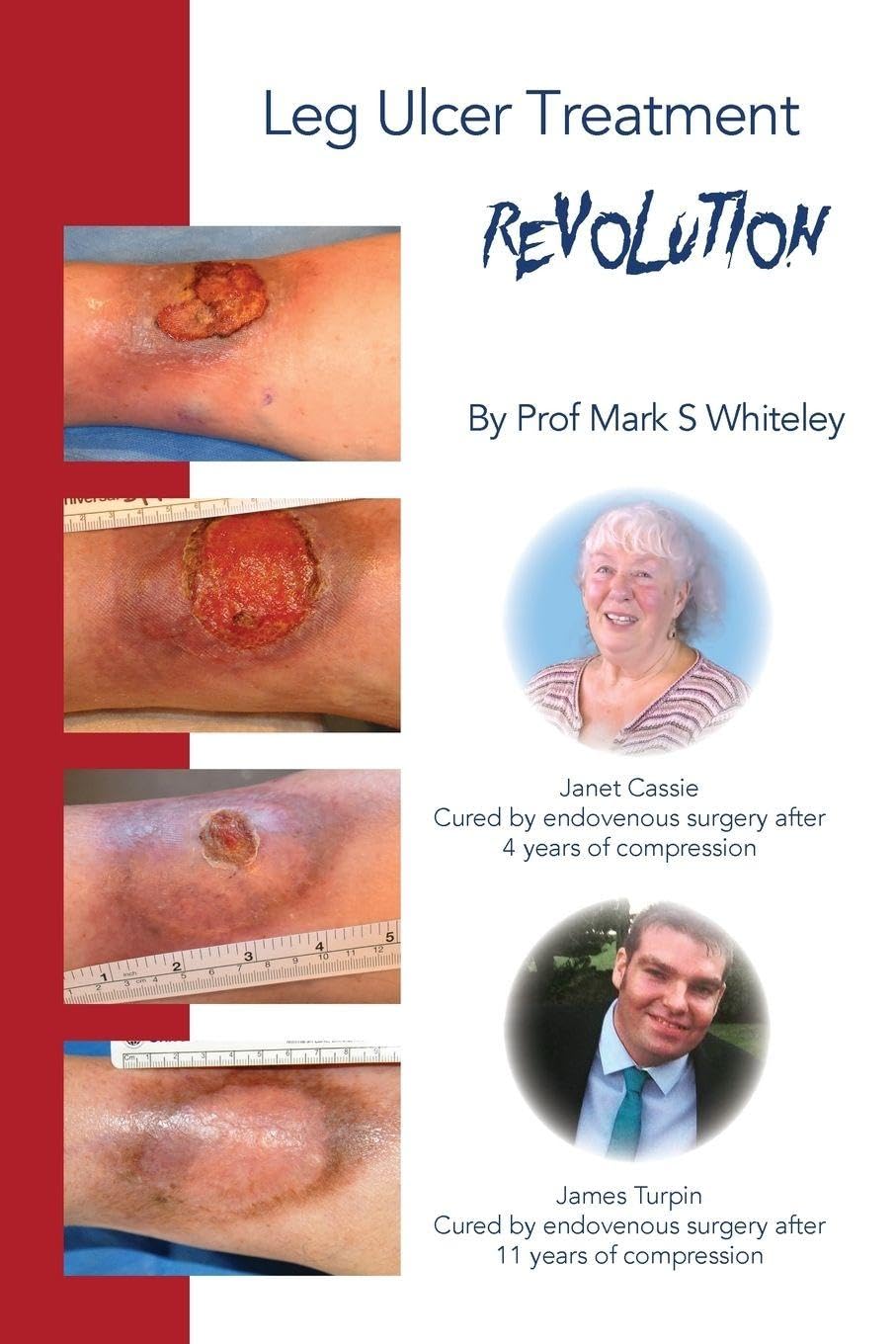 Leg Ulcer Treatment Revolution,Mark S Whiteley