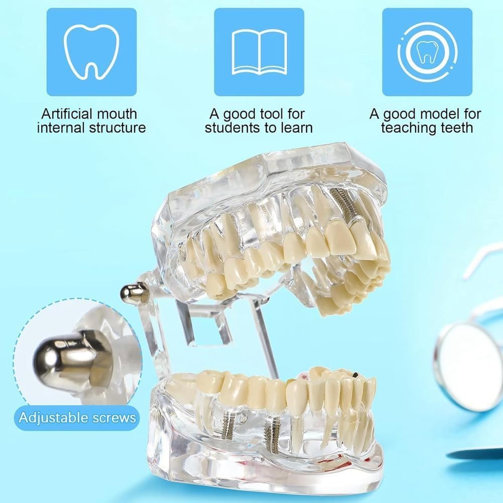 Modello di Denti Trasparente Modello di Malattie Dentali Typodont Dentale Modello di Denti per Impianti con Denti Rimovibili Dimostrazione Standard del Dente per Dentisti