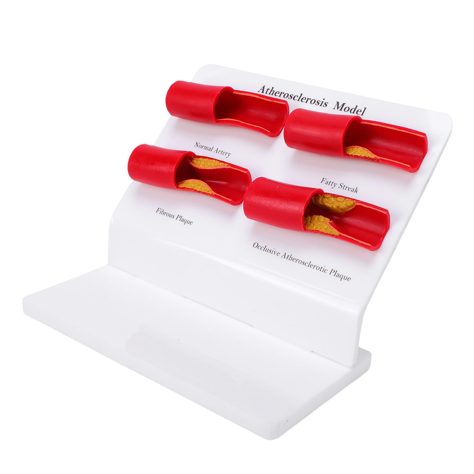 Generic Atherosklerose-Modell. Anatomisch Genaue Darstellung Arterieller Verstopfungen. Einfaches Wartungsdesign für Klinische Umgebungen
