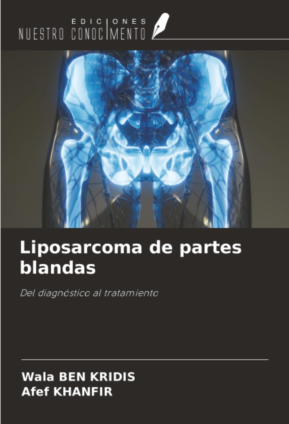 Liposarcoma de partes blandas: Del diagnóstico al tratamiento