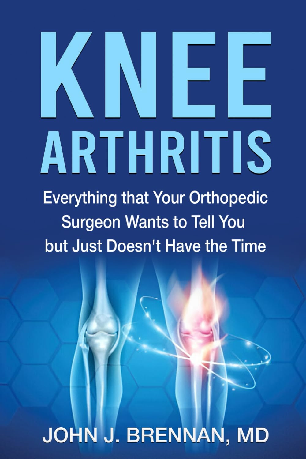 Knee Arthritis: Everything that Your Orthopedic Surgeon Wants to Tell You but Just Doesn't Have the Time