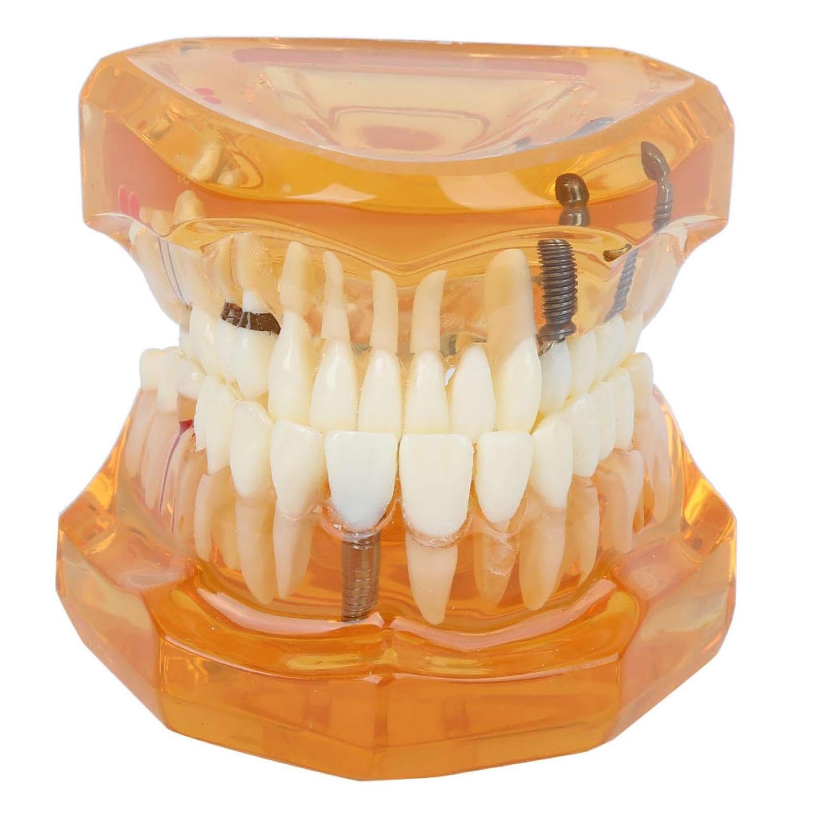 Modello di Insegnamento dello Studio Rimovibile di Malattie Dentali, Modello per Programmi Scolastici di Odontoiatria, Modello di Impianto Dentale, Strumento Dimostrativo