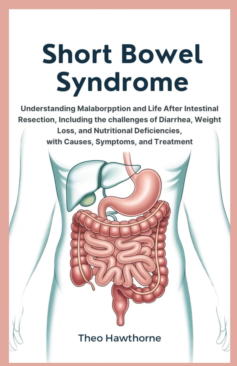 Short Bowel Syndrome: Understanding Malabsorption and Life After Intestinal Resection, Including the Challenges of Diarrhea, Weight Loss, and Nutritional Deficiencies, with Causes, Symptoms, and Treat