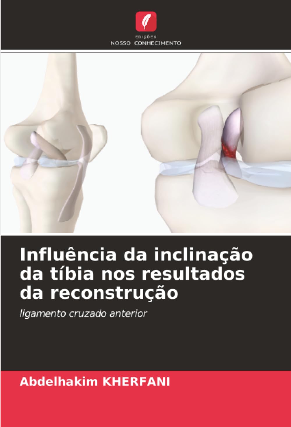 Influência da inclinação da tíbia nos resultados da reconstrução: ligamento cruzado anterior