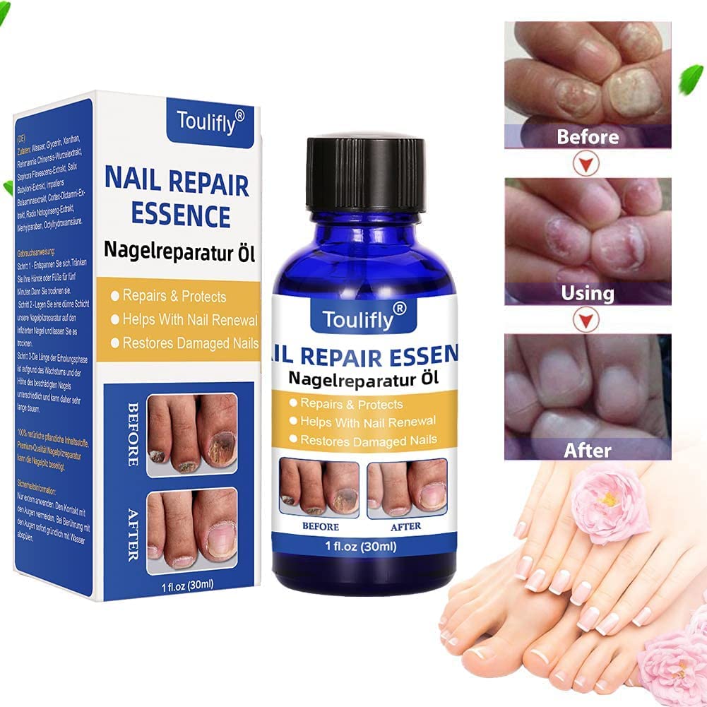 Nail Fungus Treatment for Toenail, Toenail Fungus, Nail Fungus