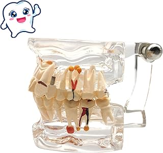 Transparent Dental Implant Disease Teeth Model Pathological Teeth Model Tooth Model Decay for Dental Students Pathology Research Education Tool for Doctor-Patient Communication