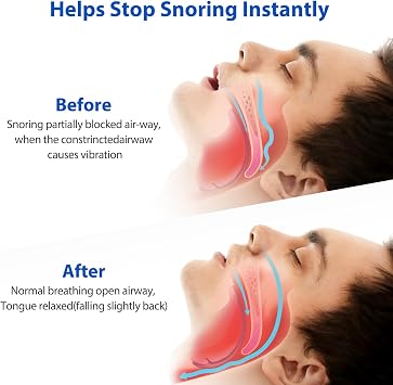 Custom Anti Snoring Devices for Sleep, Effective Anti Snoring Mouthpiece for Men Women, Soft Stop Snoring Mouth Guard, Snore Reducing Aids (Clear)