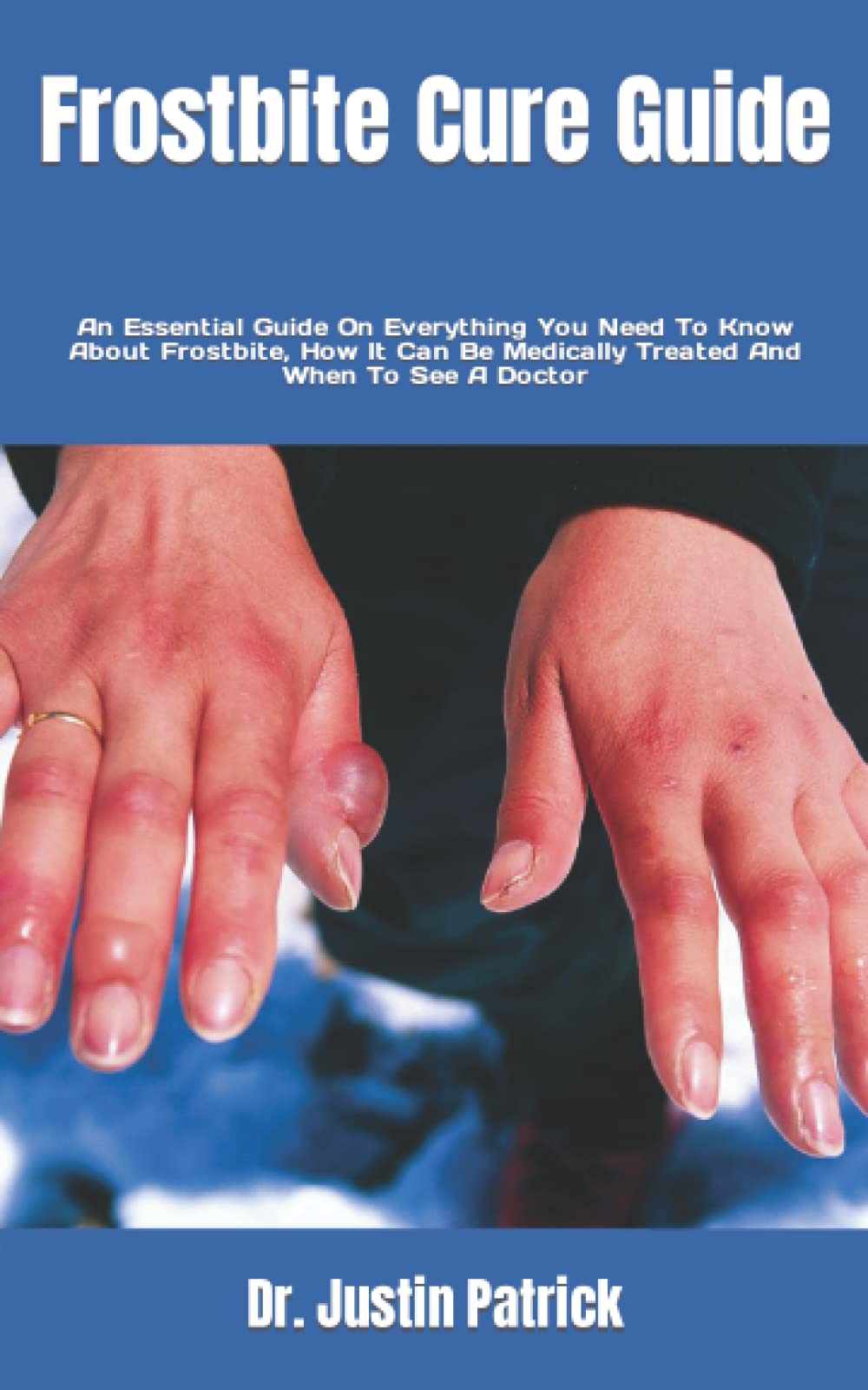 Buy Frostbite Cure Guide An Essential Guide On Everything You Need To